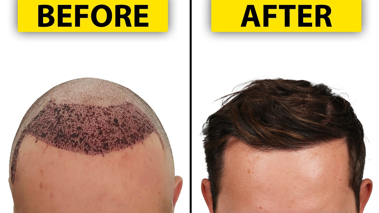 FUE Hair Transplant Results - 2 Year Journey