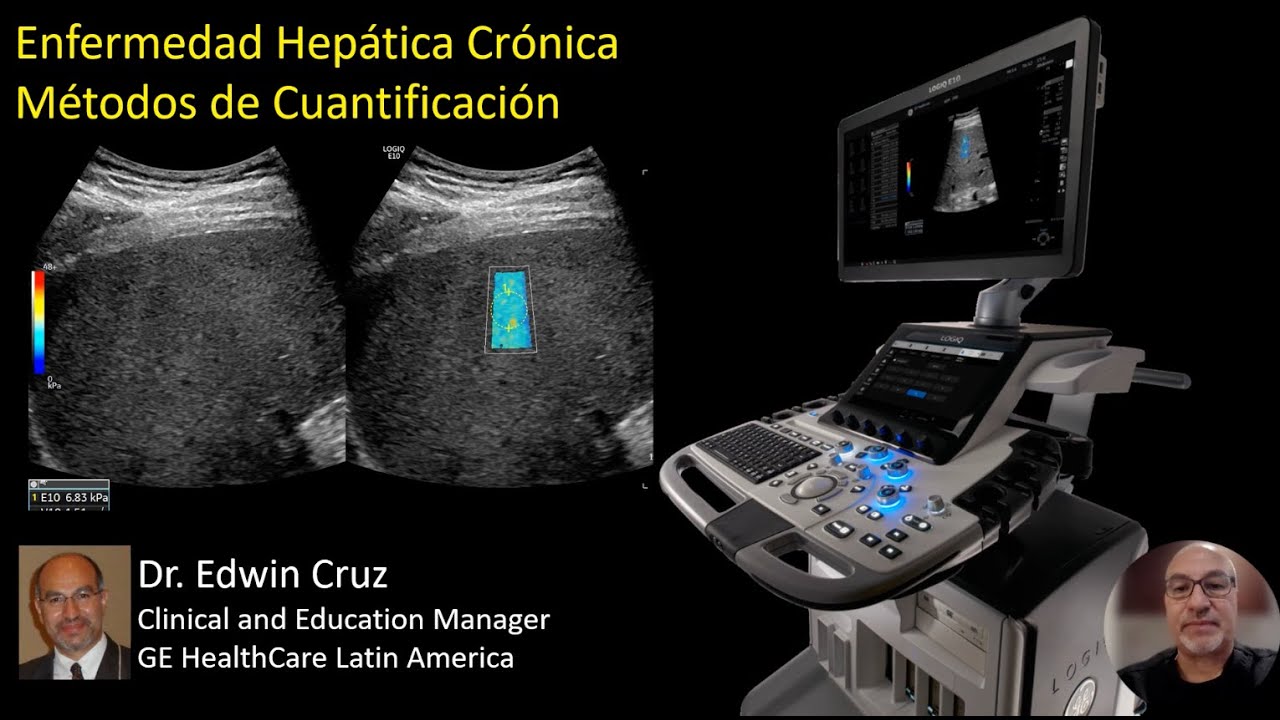 1-10 Valoración de enfermedad hepática crónica por ultrasonido | Dr. Cruz