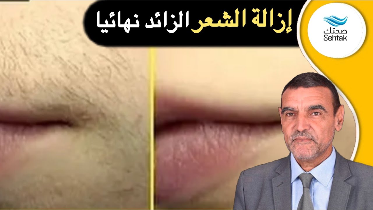 إزالة الشعر الزائد نهائيا مع الدكتور محمد الفايد