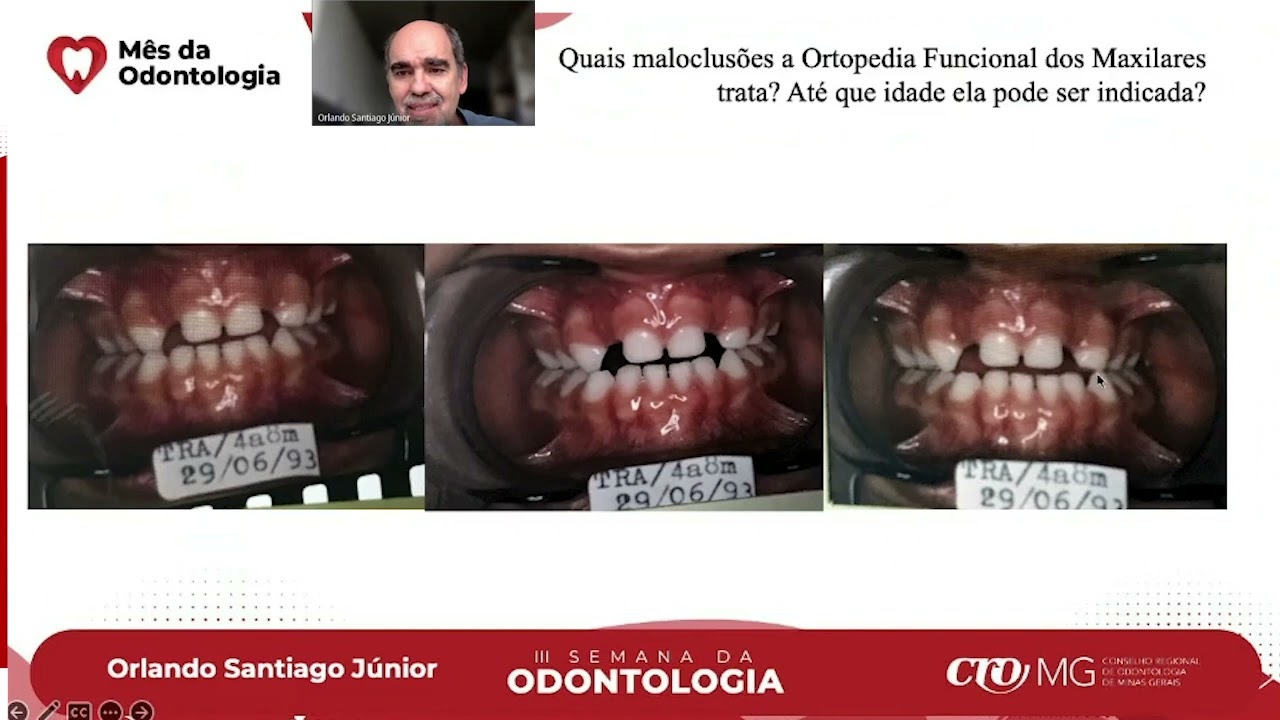 Quais maloclusões a Ortopedia Funcional dos Maxilares trata? Até que idade ela pode ser indicada?