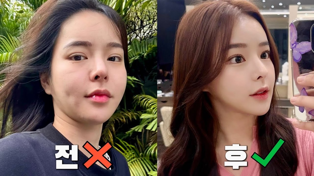 미친듯이 만족한 울쎄라 500샷+써마지 900샷 리얼 후기💯‼️ (고통 레벨, 유지 기간 등)