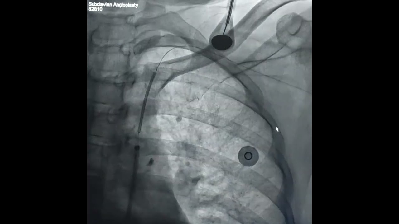 Angioplasty of Left Subclavian artery