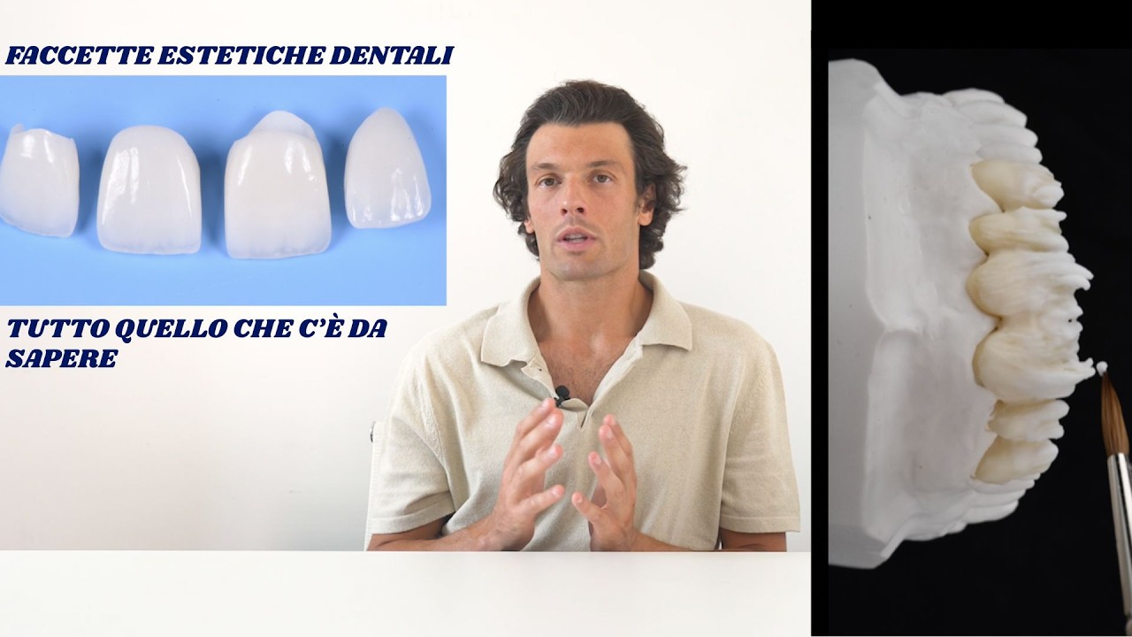 FACCETTE DENTALI  - TUTTO QUELLO CHE DEVI SAPERE