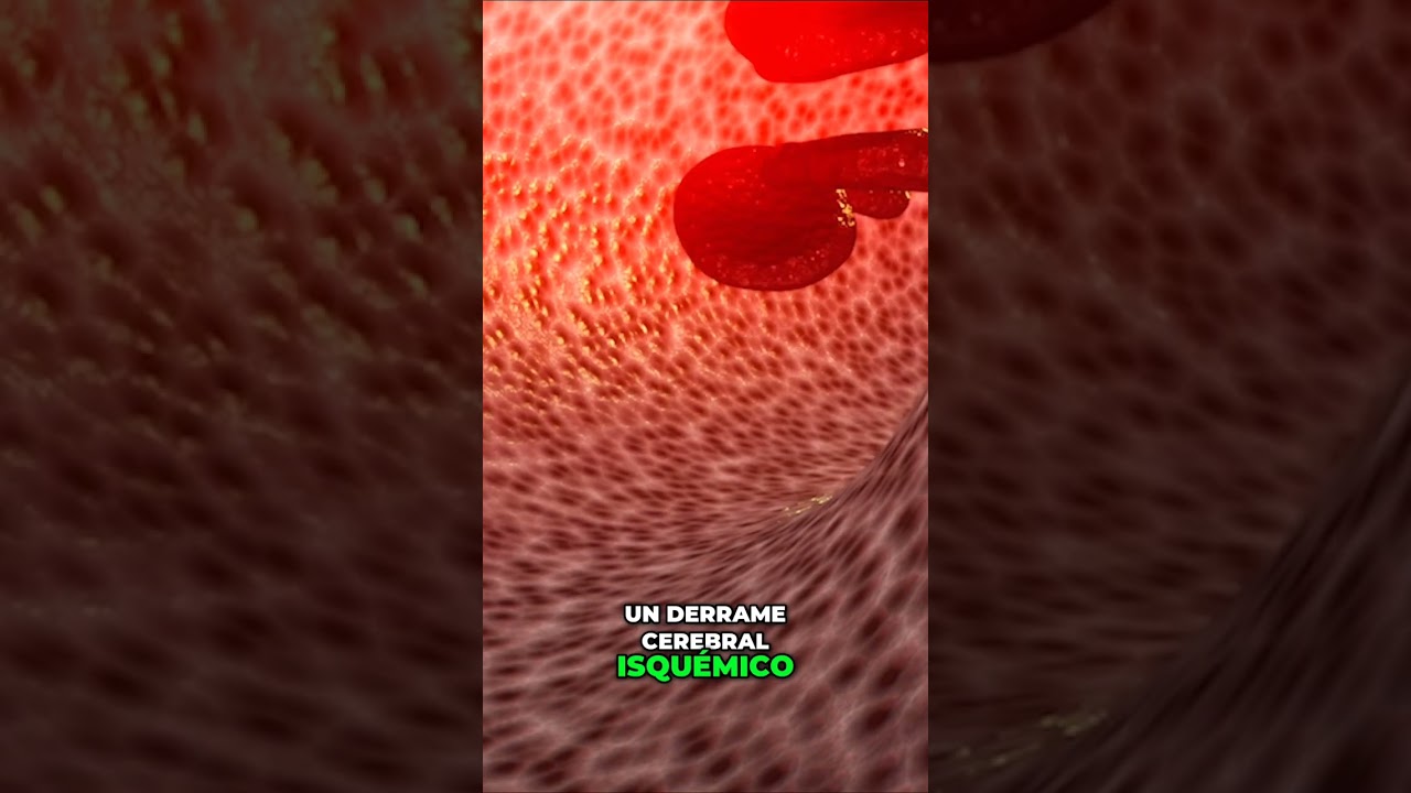 Mini derrame o infarto cerebral (ACV): 8 se&ntilde;ales en video extendido #shorts #sabiasque
