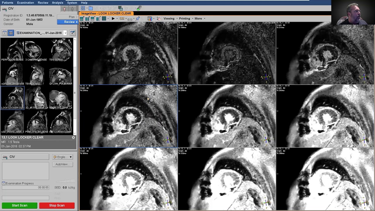 Utilidad de secuencias en Cardio Resonancia
