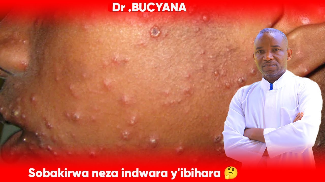 Dr BUCYANA:  REKA DUSOBANUKIRWE NEZA INDWARA Y'IBIHARA: IKIYITERA,UKO IVURWA: