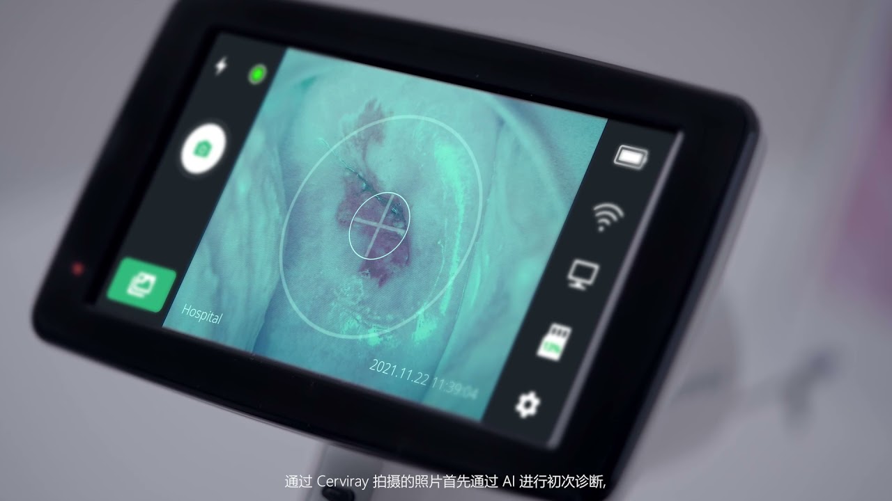 Product feature CN AIDOT 211201 Cerviray AI Cervical cancer screening