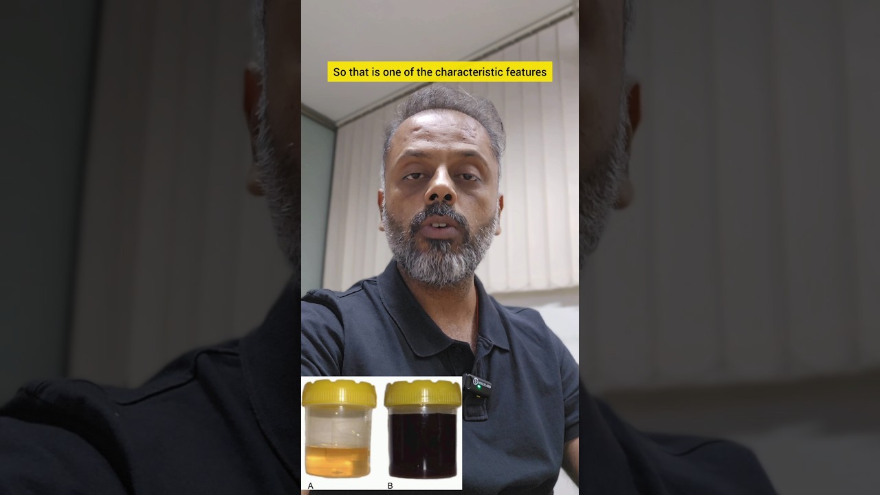 Alkaptonuria In 3 Minutes || Amino Acid Metabolism Disorder || Alkaptonuria  