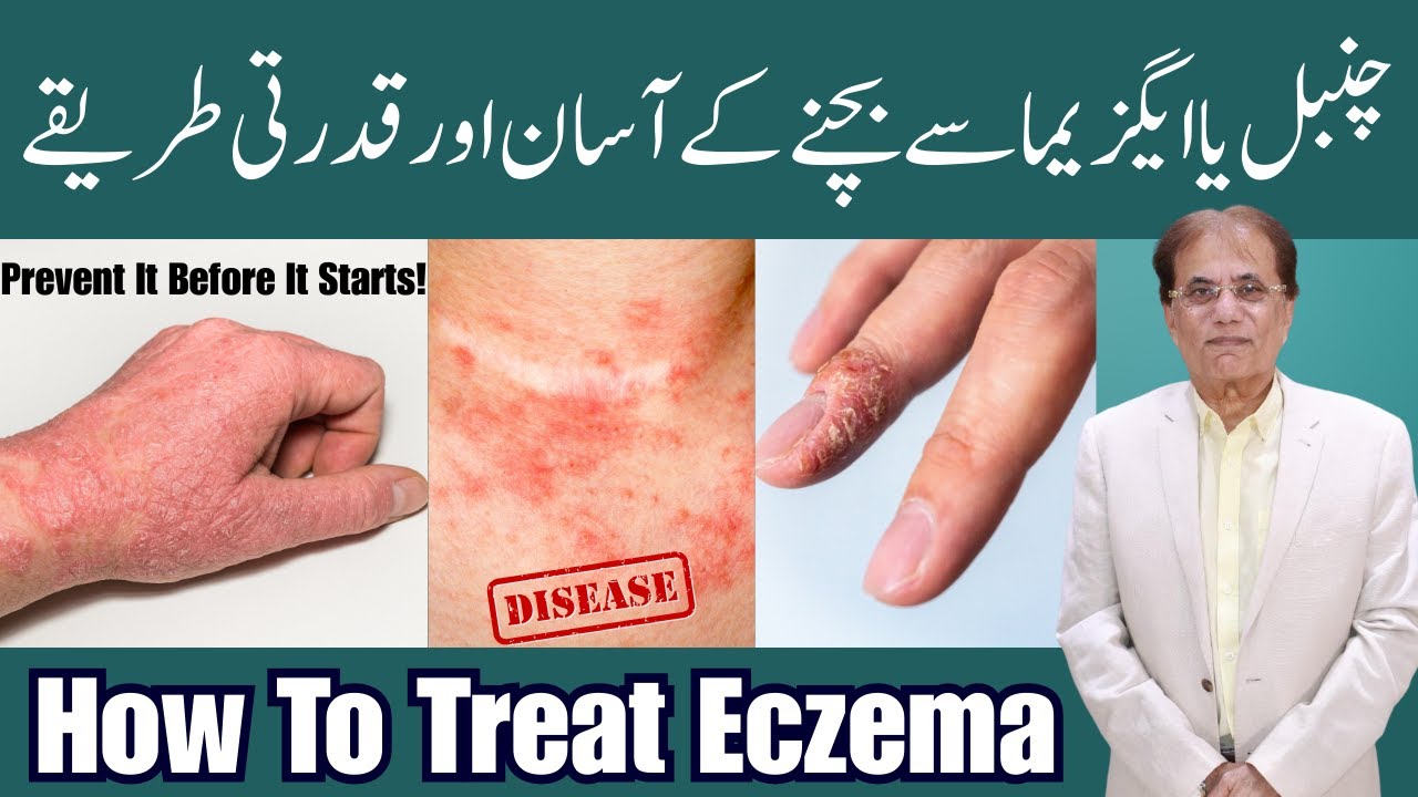 Top 5 Eczema Causes and Prevention I Dr Atif Kazmi