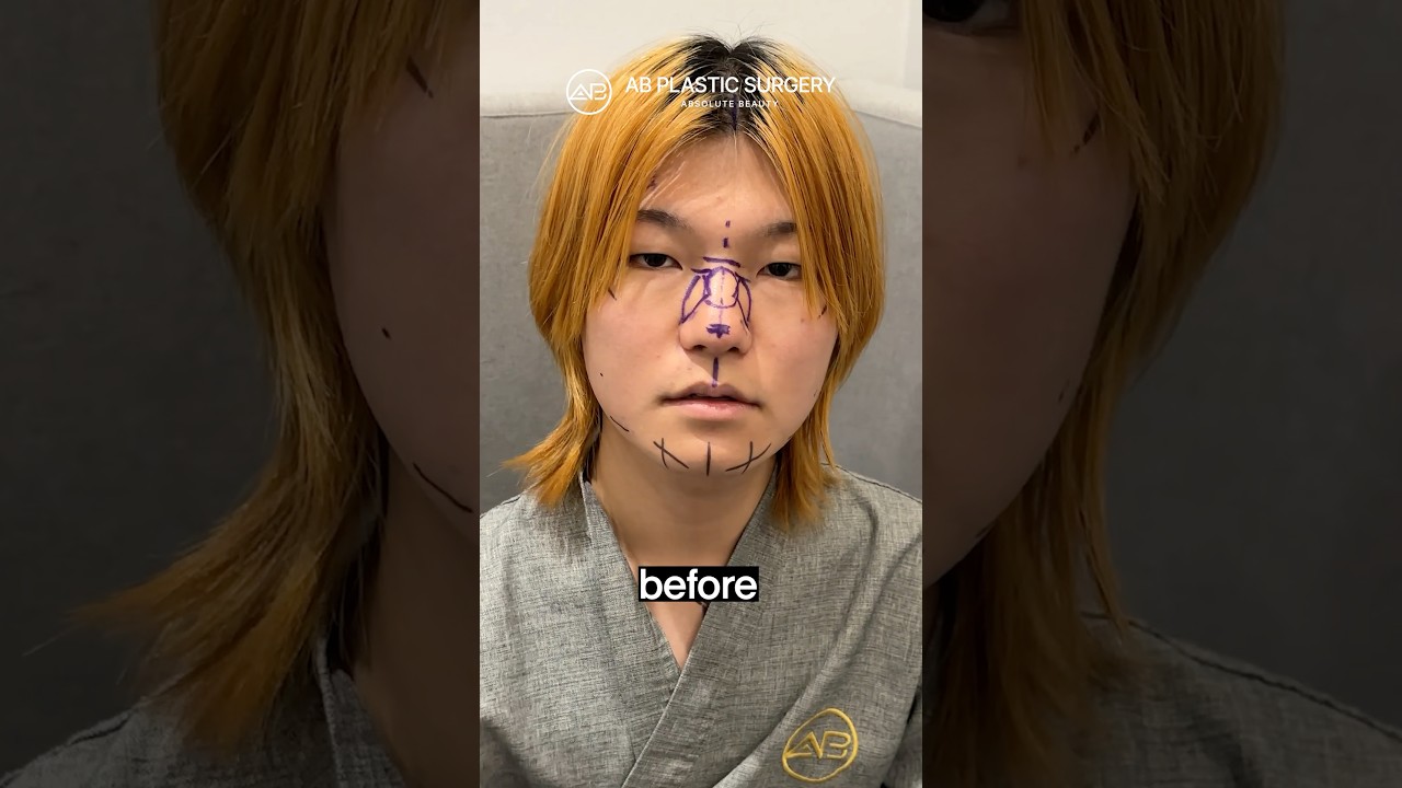 MTF Facial Feminization Dramatic Transformation! #koreanplasticsurgery