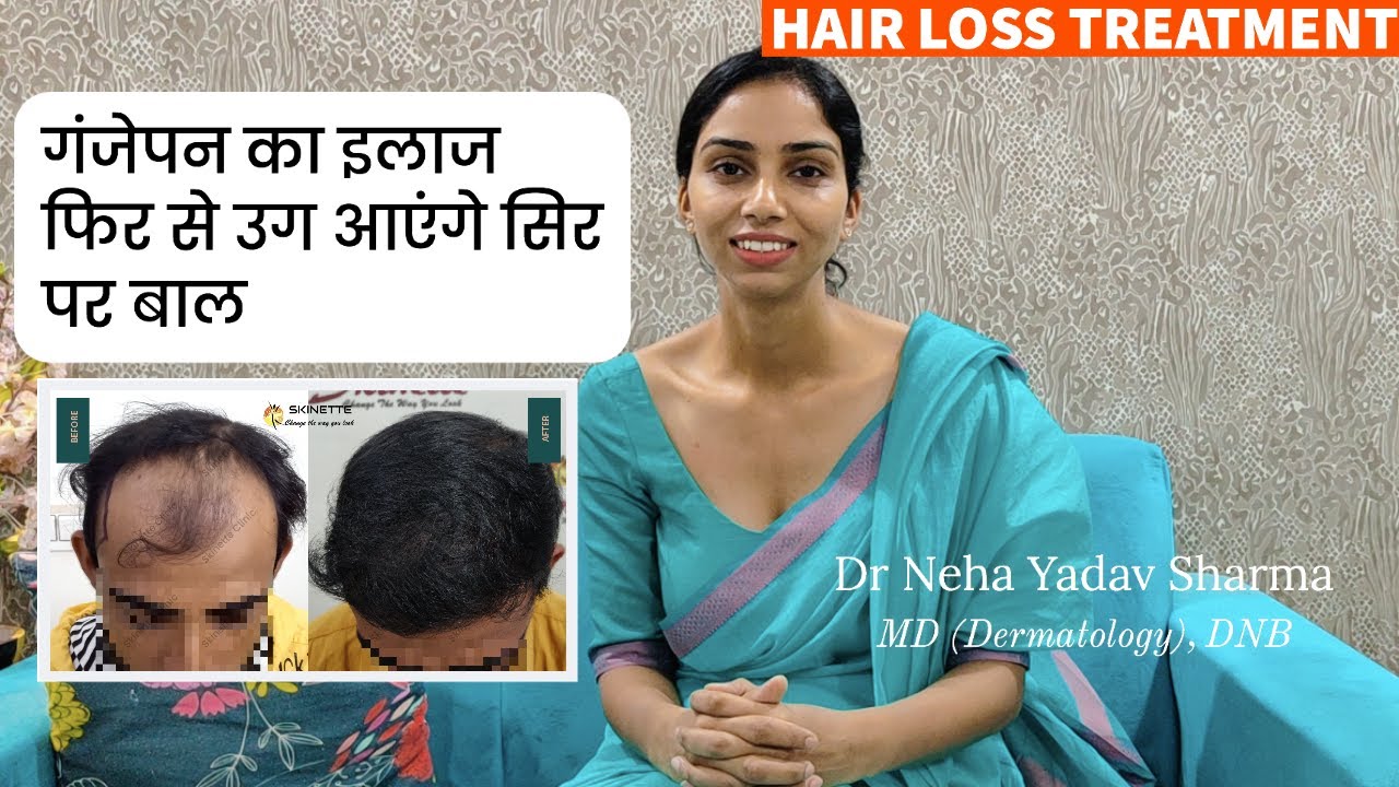 STOP Hair Loss & Regrow Your Hair | Understanding Hair Loss Causes in Men (AND HOW TO FIX IT) HINDI