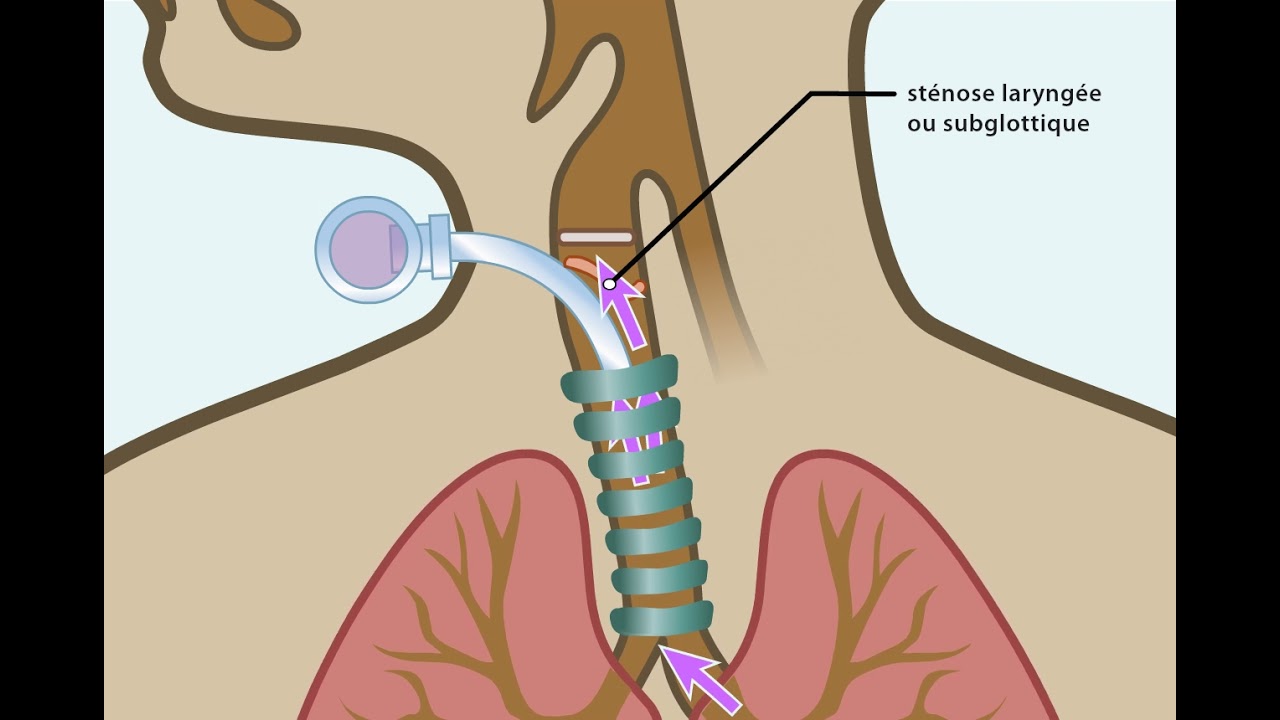 La canule de trachéotomie: Valve de phonation et bouchons [en français]