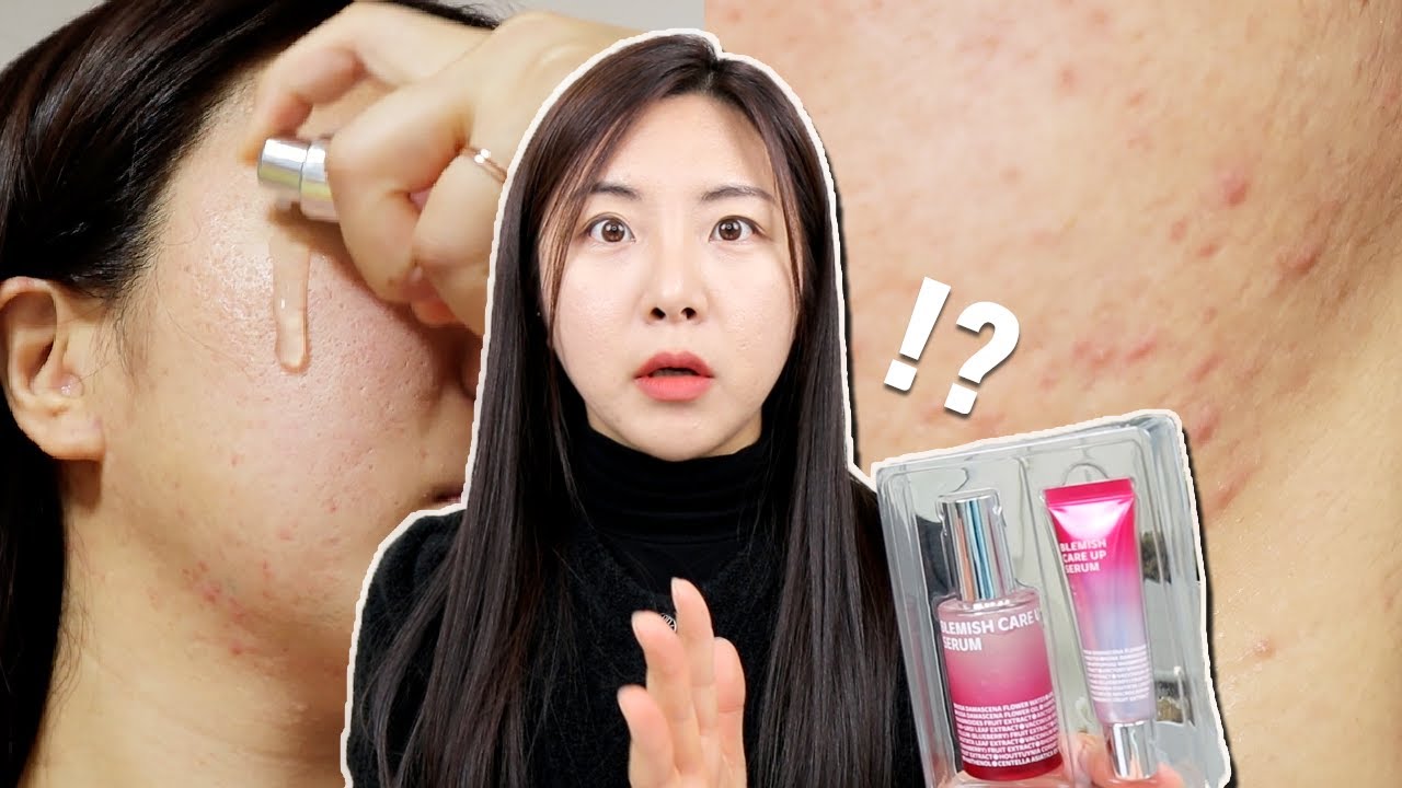 10년 간 올리브영 1위 잡티세럼 진짜 좋을까?🔥 트러블, 흔적 피부의 한달 사용 리뷰!!