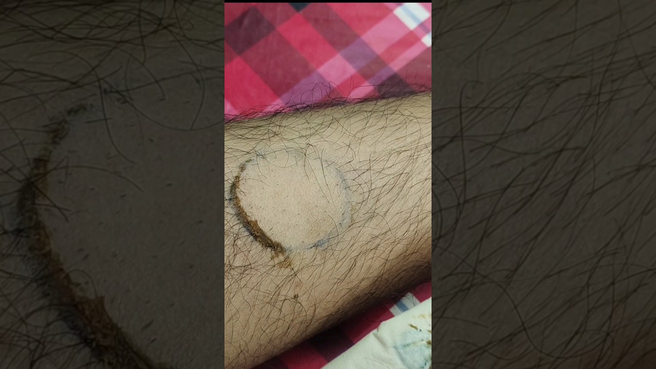 #ad #unwantedhair #hairremoval #hairremovaltreatment #unwantedsoul #trendingshorts #trending