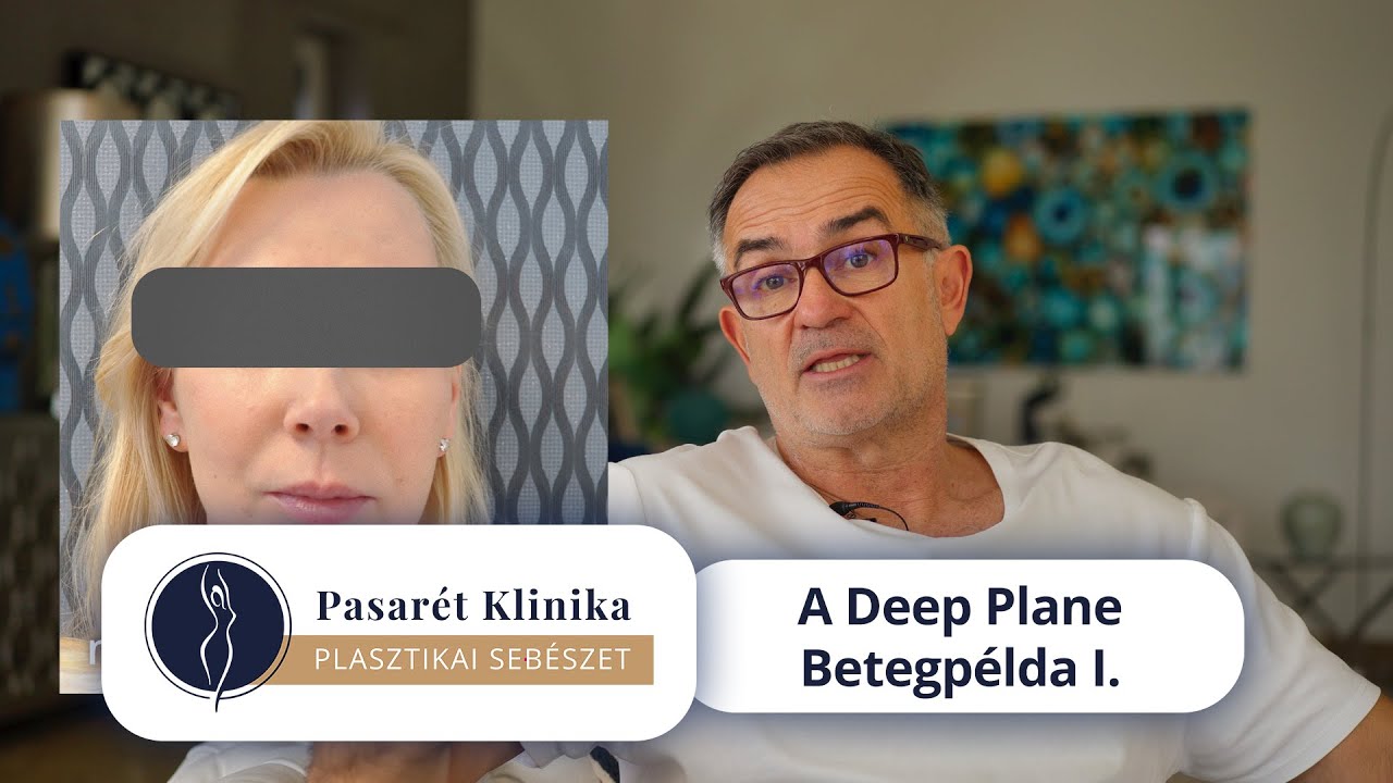 Deep Plane arcplasztika - betegpélda I.