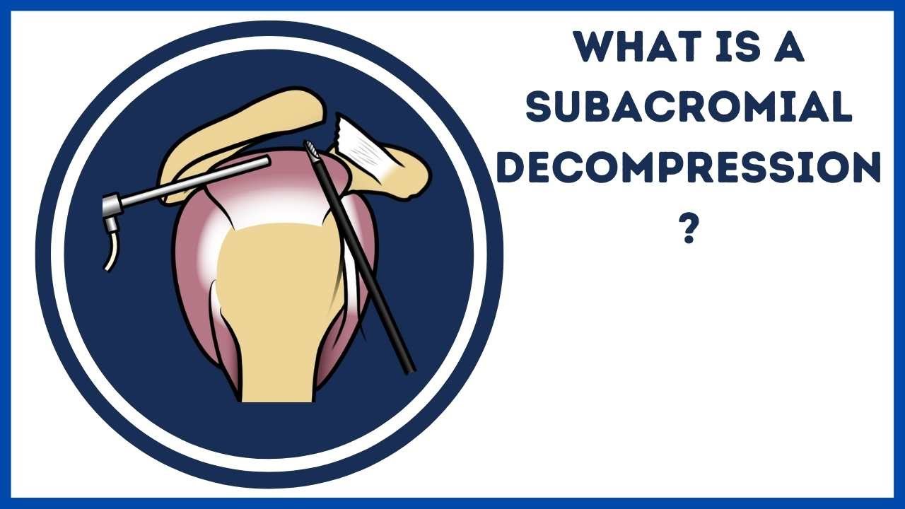 What is a subacromial decompression?