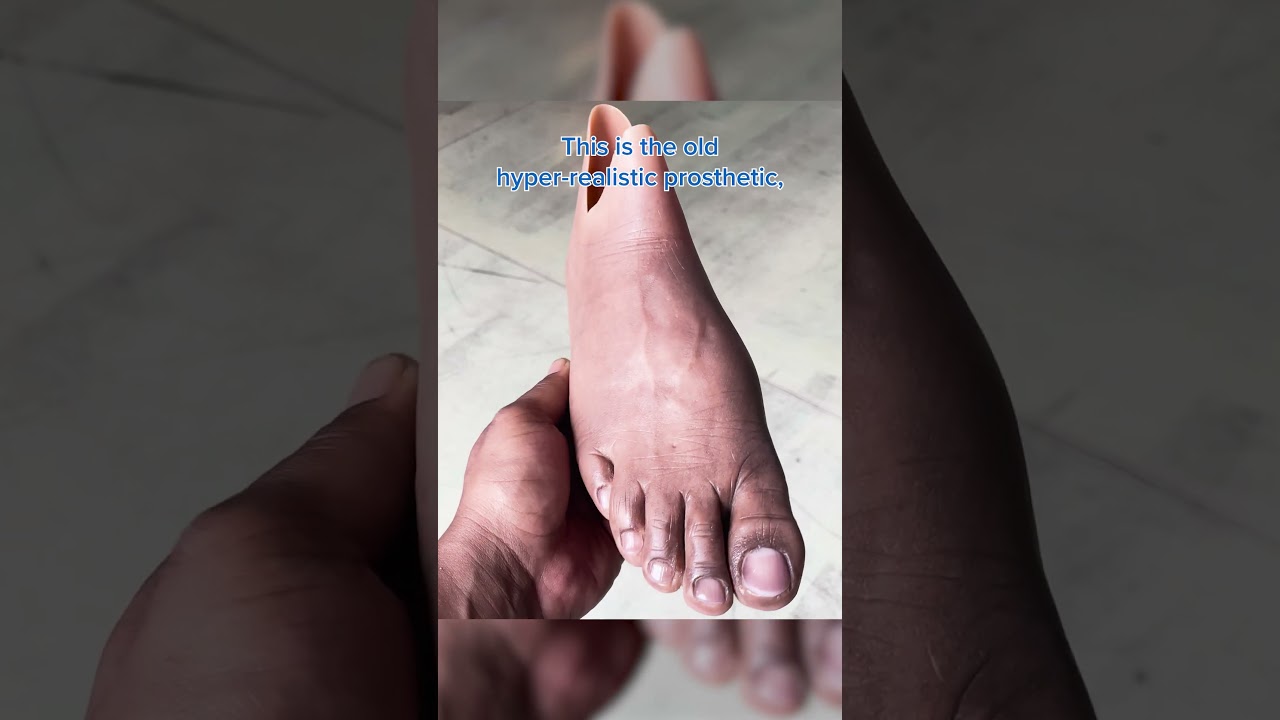 Formlabs Helps Sydney Get a Custom 3D-Printed Prosthesis