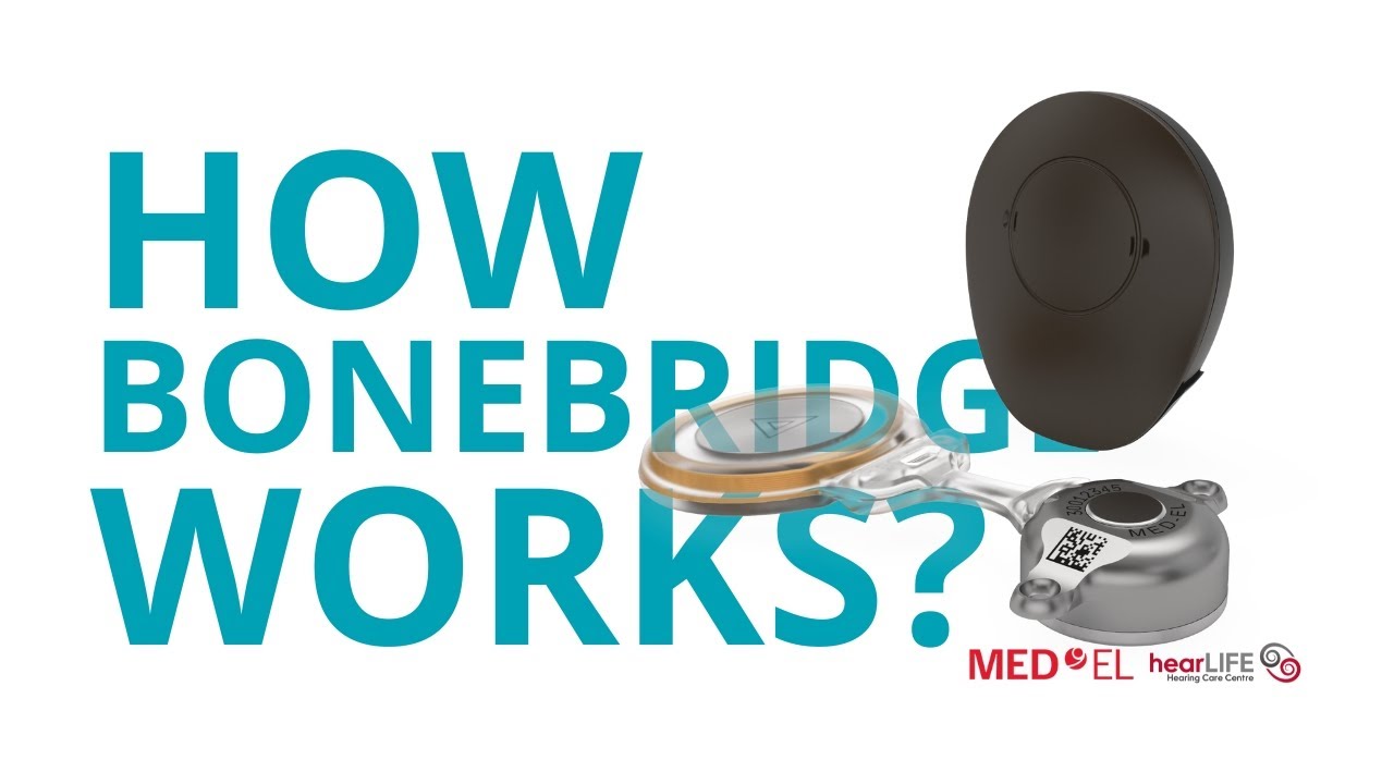 How the BCI 602 Works with SAMBA 2 | Bone Conduction Hearing System by MED-EL | HearLIFE Singapore