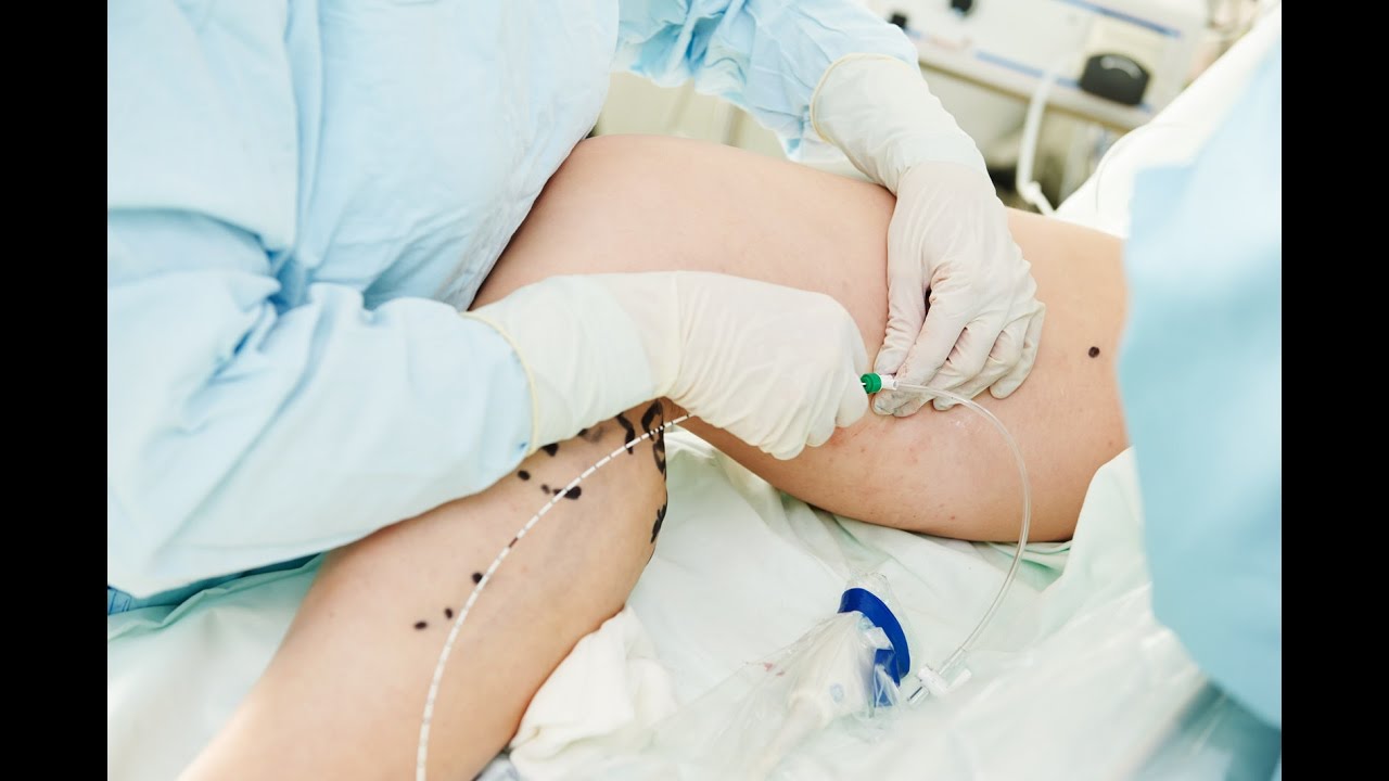Lazerle Varis Tedavisi (Endovenöz Lazer Ablasyon) Nedir, Nasıl Yapılır?