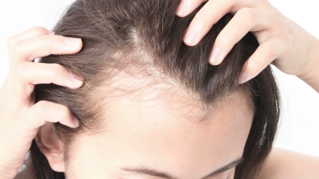 MINOXIDIL COMO USAR