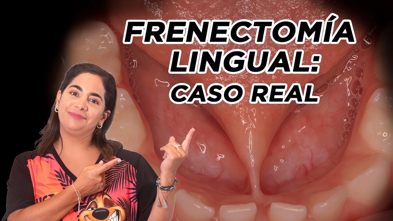 Frenectomía lingual: caso real