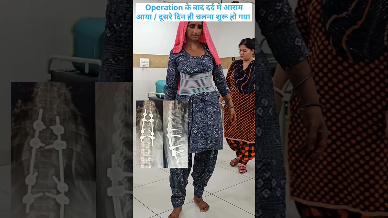 Patient Walking After Spine Surgery For TB Spine! @NeuroMedTalks01 #spine #neurosurgeon