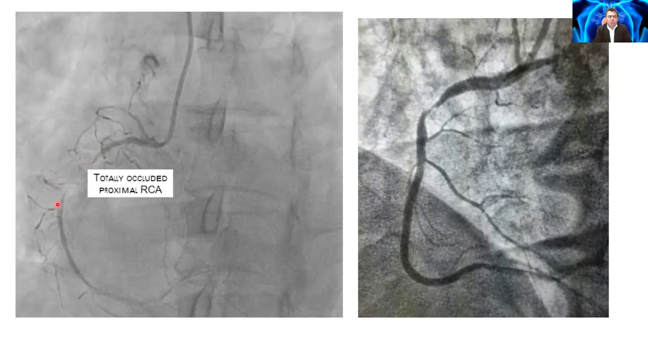 INTERPRETANDO ANGIOGRAFIAS CORONARIAS DR. DANIEL MENESES