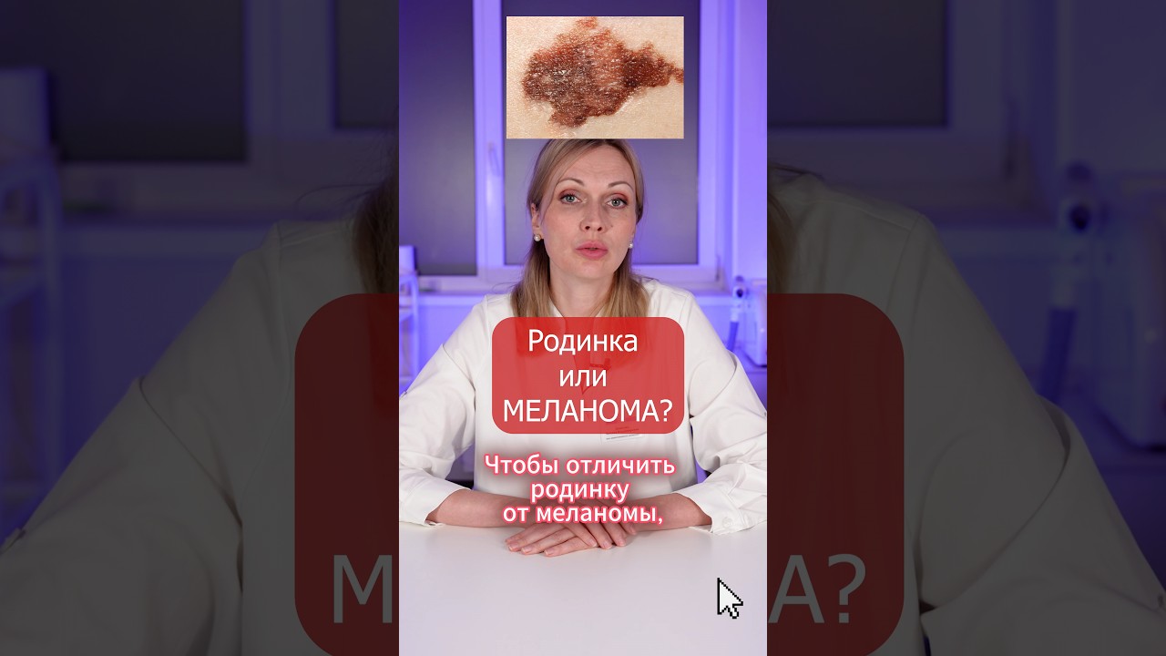 РОДИНКА или МЕЛАНОМА: КАК выглядит РАК КОЖИ?
