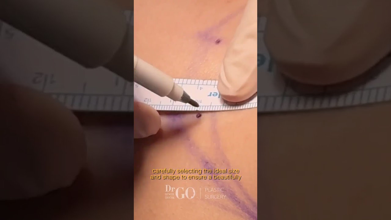 Achieving Natural Elegance with 300cc Round Breast Implants