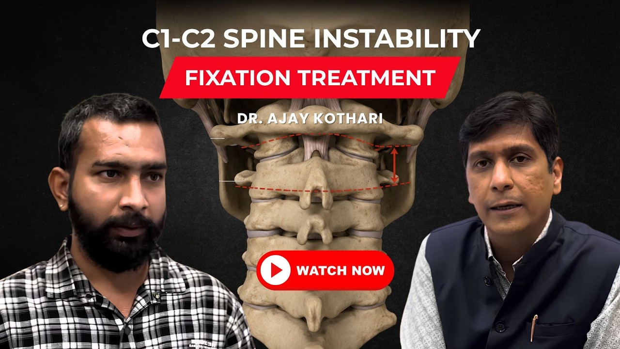 C1-C2 spine instability- fixation treatment #backpain #neckpain #spine #roboticspinesurgery #pune