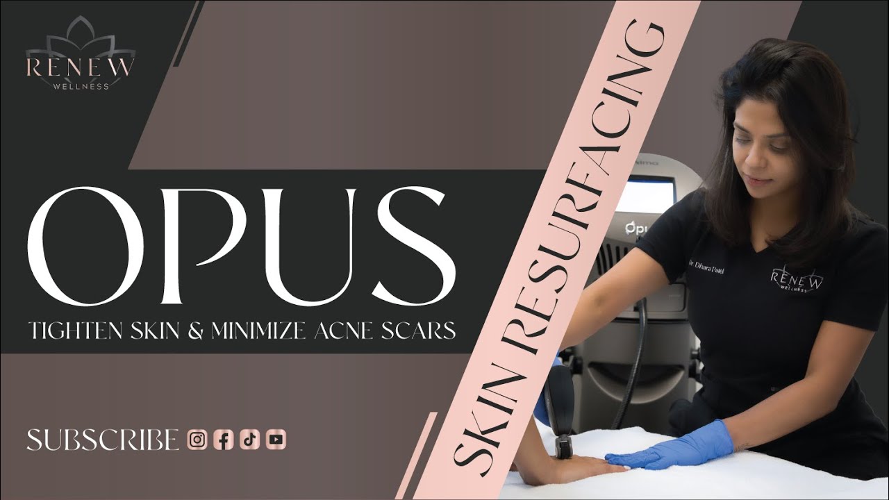 Reduce Acne Scars & Tighten Your Skin With Opus Plasma Skin Resurfacing!
