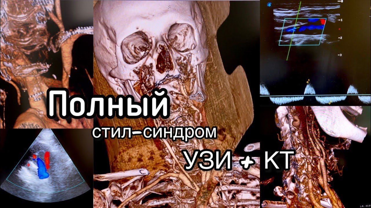 Полный стил-синдром. Диагностика на УЗИ и КТ. Болезнь Такаясу.