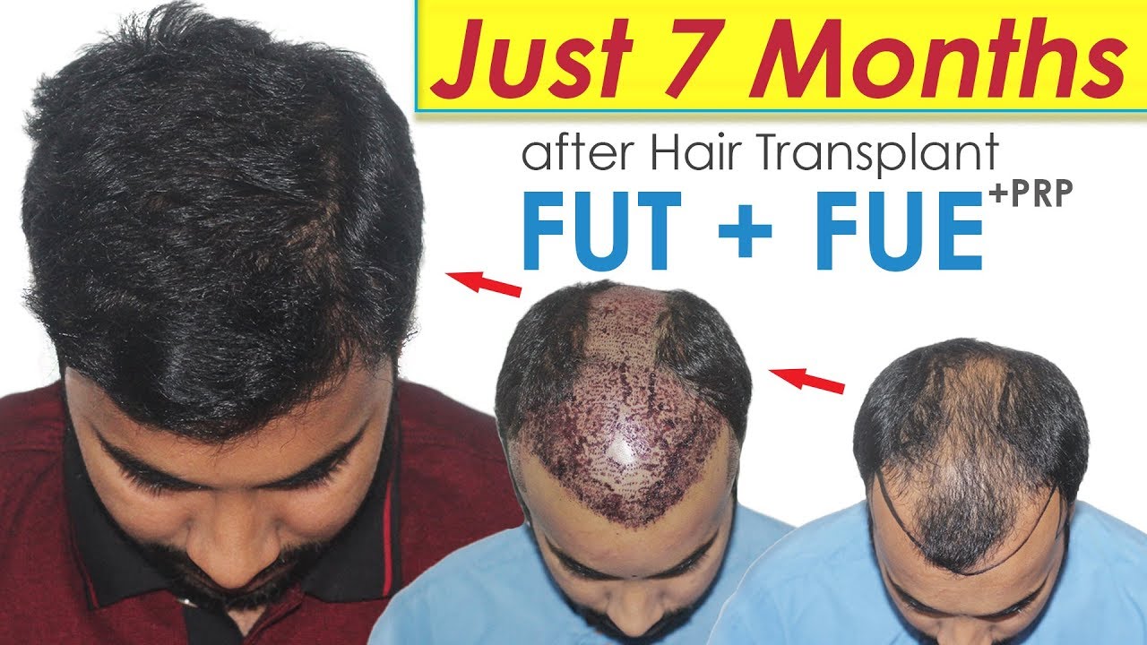 Must SEE Hair Transplant Results by COMBO TECHNIQUE | Dr Suneet @ Medispa India | Jaipur Delhi | USA