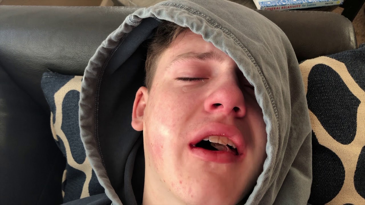 Crying for Jimmer Post-Wisdom Teeth Removal