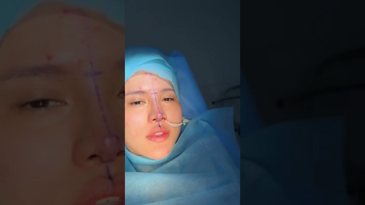 Mũi cấu trúc sụn tai