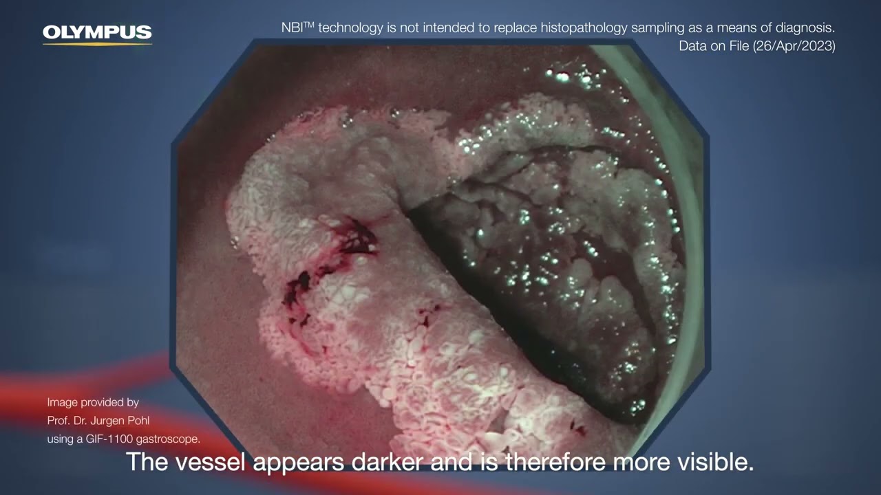 Narrow Band Imaging&trade; NBI&trade; Technology