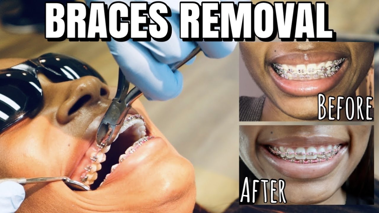 Getting my Braces Removed after 2 Years (Very Detailed Process!!)