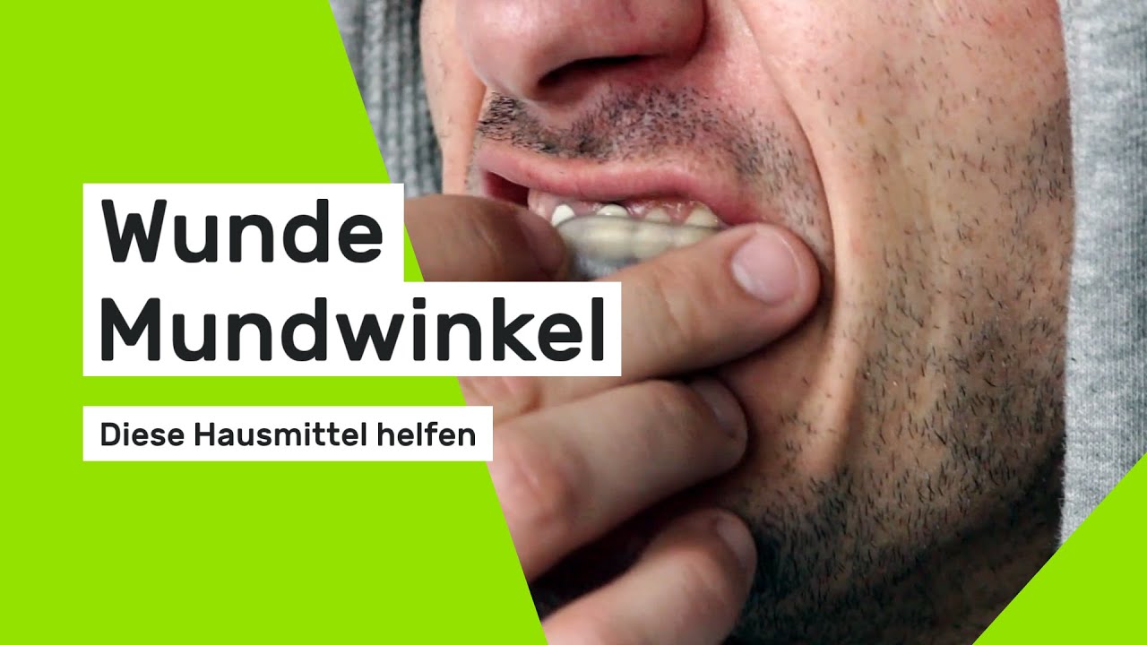 Wunde Mundwinkel: Diese Hausmittel helfen