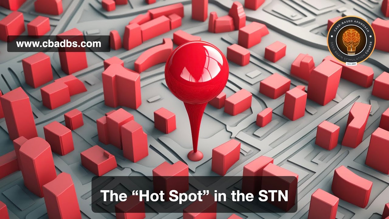 The “Hot Spot” in the STN: Where to Stimulate for Best Outcomes in DBS