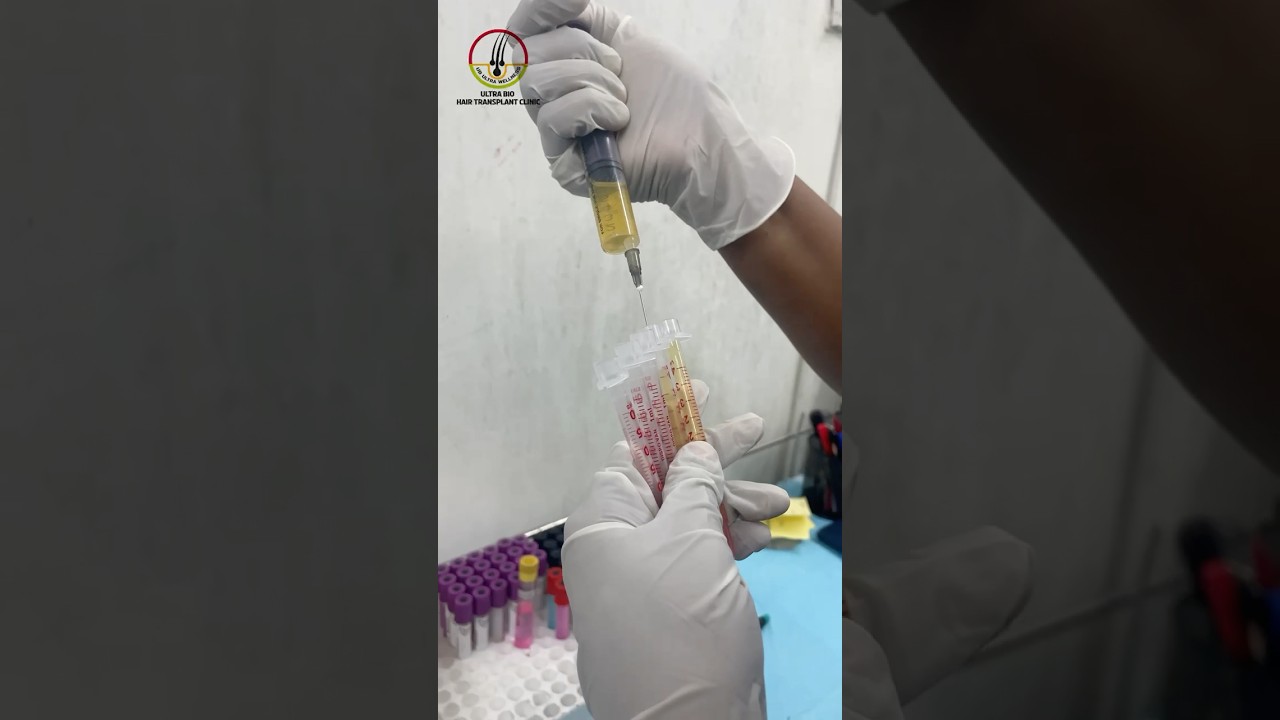 Ultra bio hair transplant clinic CONTACT NUMBER 75300 77320 
