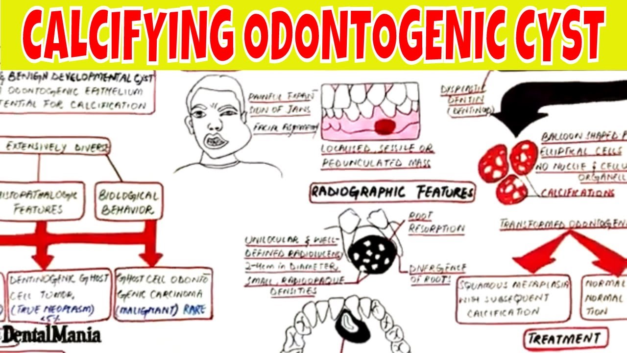 Calcifying Odontogenic Cyst - Clinical, radiographic,  Histopathologic Features and Treatment