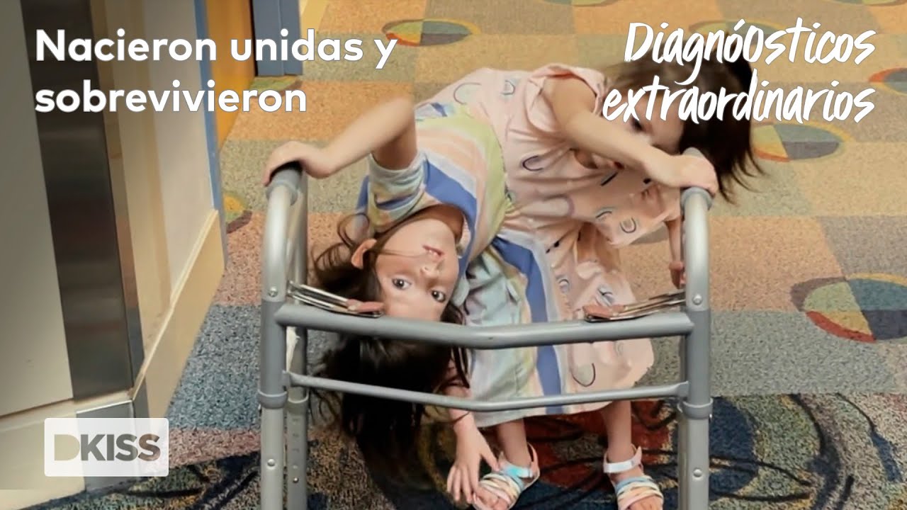 Gemelas unidas por el cuerpo, separadas por su carácter | Diagnósticos Extraordinarios