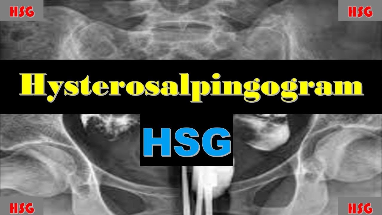 Hysterosalpingogram | HSG