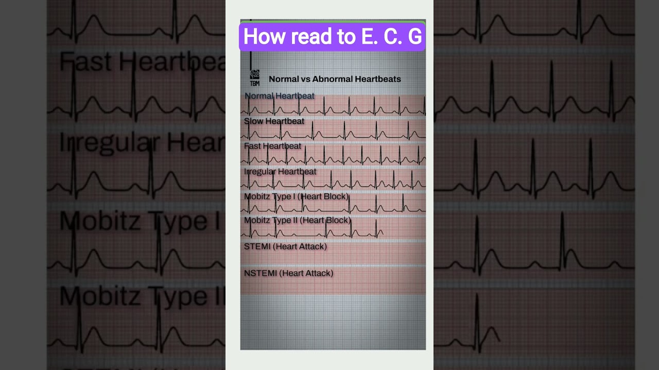 how read to E.C.G