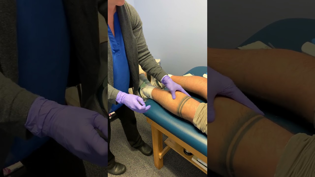Dry Needling For Calf Pain in Runners