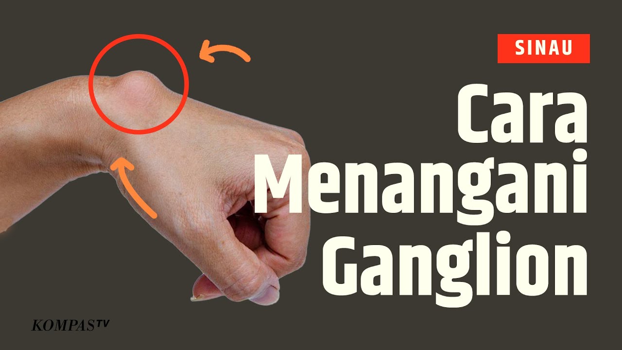 Apa itu Ganglion dan Bagaimana Cara Menanganinya? | SINAU