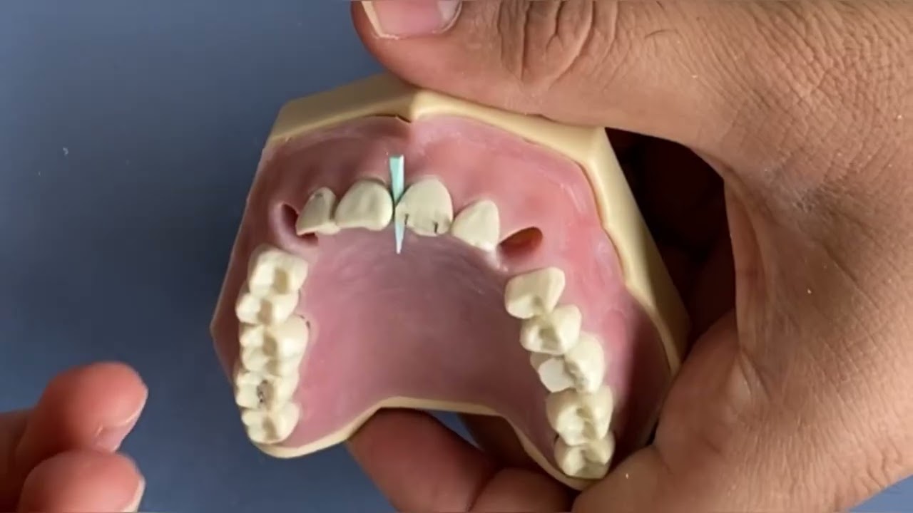 Preklinik 2. Sınıf Anterior dişlerde dentin pini uygulanması