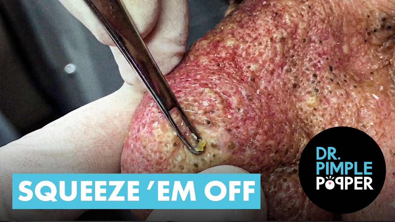 Squeeze &rsquo;Em Off