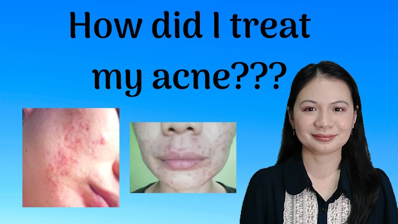 Tips For Acne and Pimple Free Skin