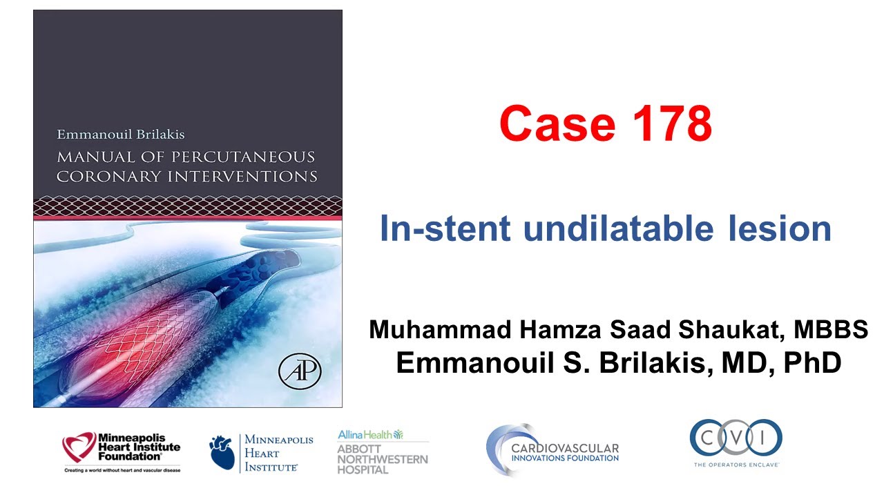 Case 178: Manual of PCI - In-stent undilatable lesion